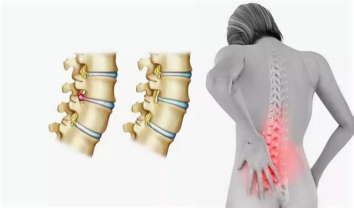 panganib ng spinal osteochondrosis