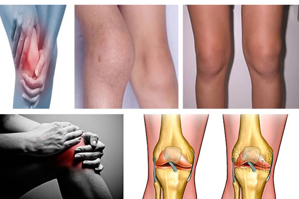 Mga sintomas ng arthrosis ng tuhod
